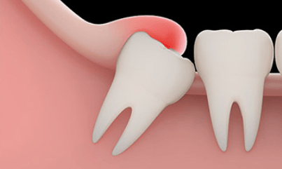 impacted-wisdom-teeth-infection