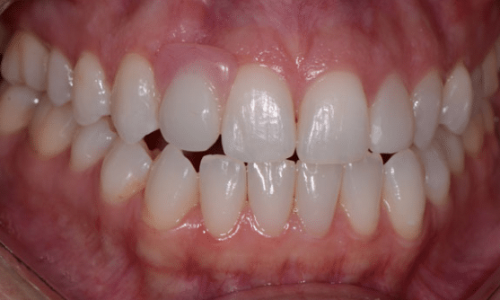 After clear aligners