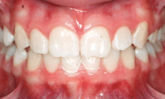 After clear aligners