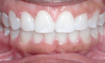 After clear aligners