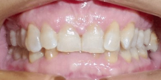 invisalign-before-3-san-clemente