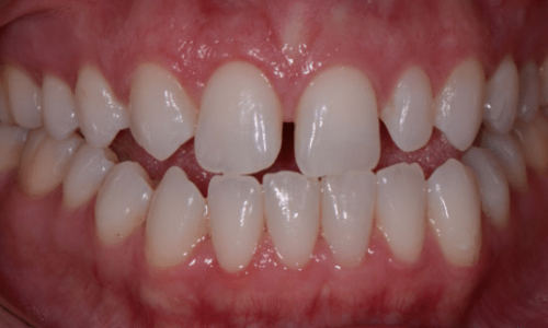 After clear aligners