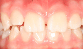 After clear aligners