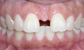 After clear aligners