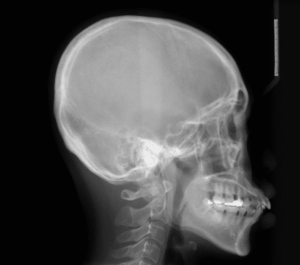 Lateral-cephalometric-ceph-xray