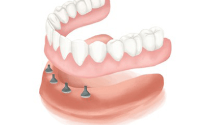 overdenture-four-implants