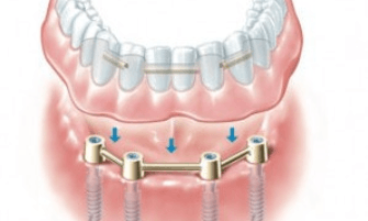 overdenture-implant-bar