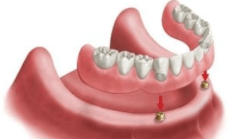 overdentures-two-implants