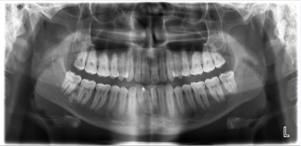 X rays radiographs oceansight dental implants