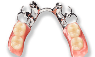 partial-denture-metal