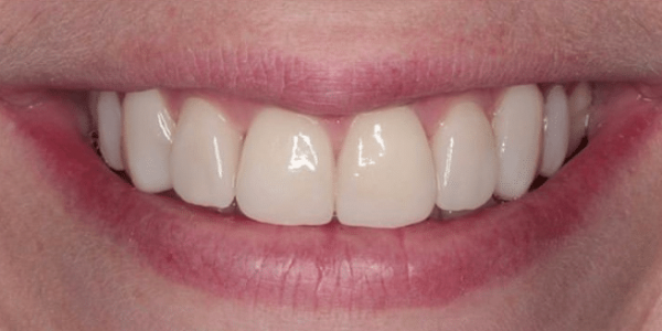 porcelain-veneers-after-1-san-clemente