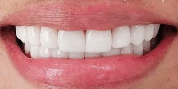 porcelain-veneers-after-2-san-clemente