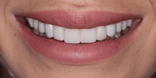 porcelain-veneers-after-3-san-clemente