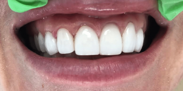 porcelain-veneers-after-4-san-clemente