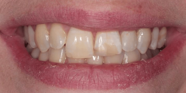 porcelain-veneers-before-1-san-clemente