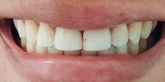 porcelain-veneers-before-2-san-clemente