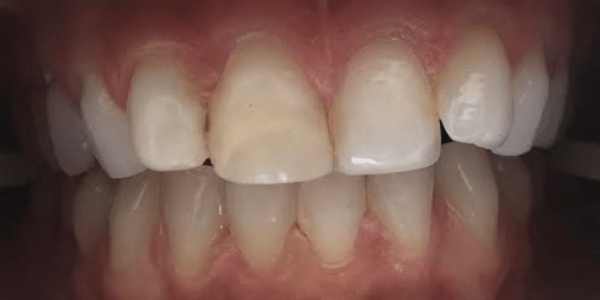 porcelain-veneers-before-4-san-clemente