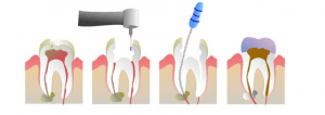 root-canal-procedure