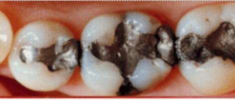 silver-dental-fillings