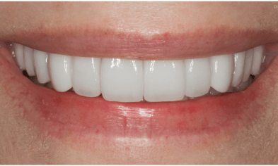 after-porcelain-veneers