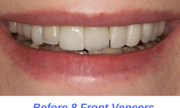 before-porcelain-veneers