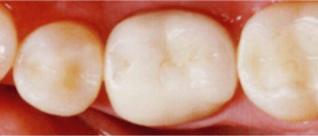 white-dental-fillings