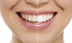 teeth-whitening-candidate