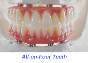 all-on-four-dental-implants