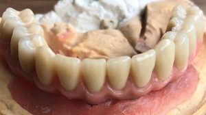 Example-all-on-four-teeth-prosthesis