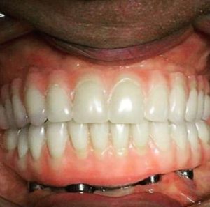 Sample-all-on-four-dental-implants