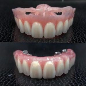 Comparison-full-dentures-versus-all-on-four-teeth
