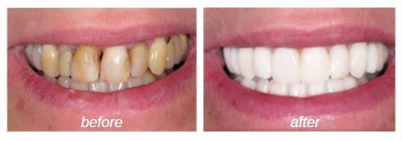 cosmetic-dentistry-porcelain-veneers