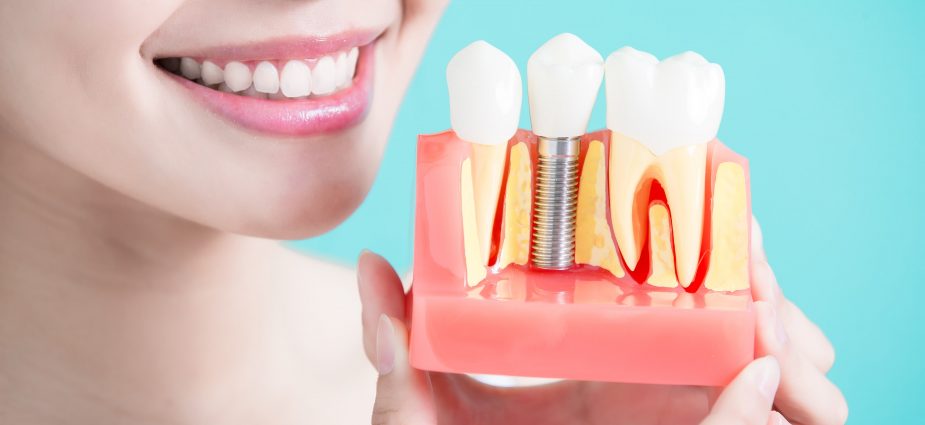 Facts About A Dental Implant Cost