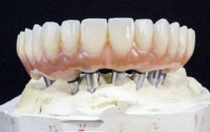 implant-dentistry-options