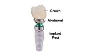 dental-implant-parts