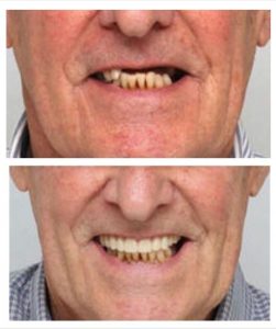 benefits-dental-implants
