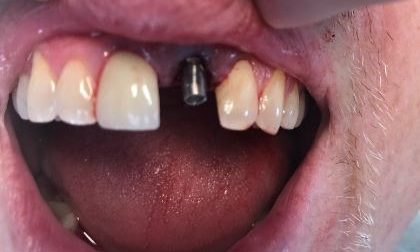 tooth-in-a-day-implant-placement