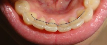 Fixed-orthodontic-retainer