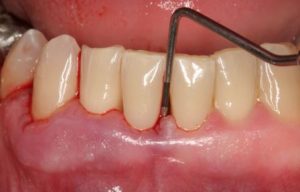 Gum-disease-periodontitis