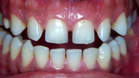 Invisalign-gaps-teeth