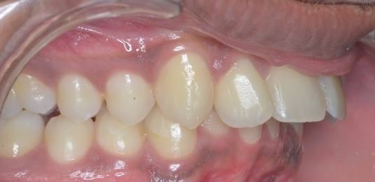 Invisalign-severe-overbite