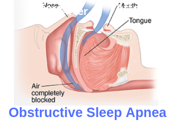 Obstructive-Sleep-Apnea