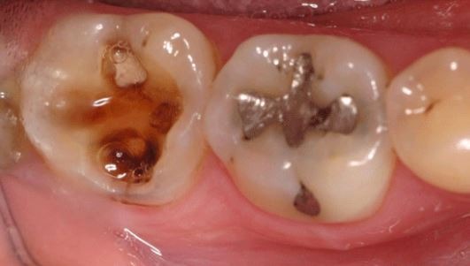 Replacing-large-silver-dental-fillings