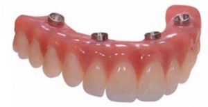 all-on-four-porcelain-teeth