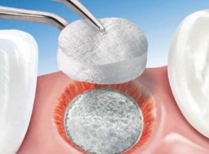 bone-graft-tooth-extraction