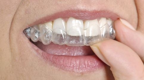 clear-aligner-Invisalign-treatment