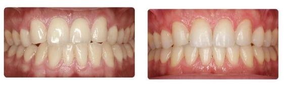 cosmetic-dentistry-invisalign-clear-aligners