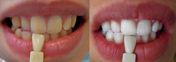 cosmetic-dentistry-teeth-whitening