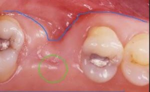 dental-bridge-insufficient-bone