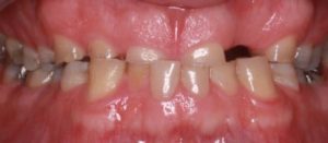 dental-bridge-multiple-crowns